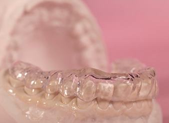 Oral appliance on model teeth