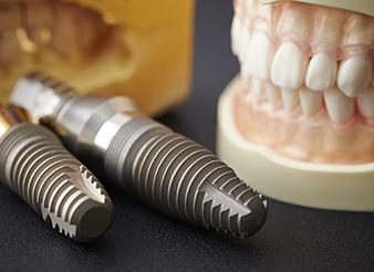 Model smile and dental implants