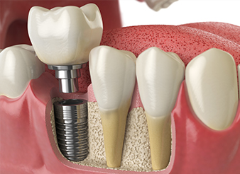 Animation of implant supported dental crown