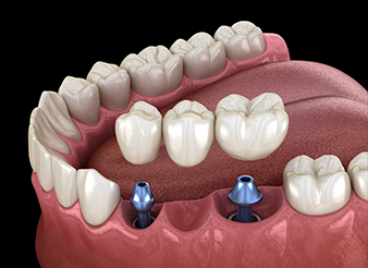 Animation of implant supported fixed bridge