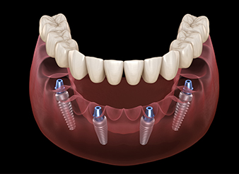 Animation of implant supported denture