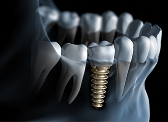 Animation of implant supported dental crown