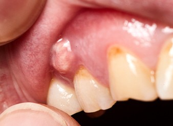 An individual’s exposed top gums that show a pocket of pus signaling an abscess