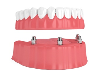 implant-retained dentures