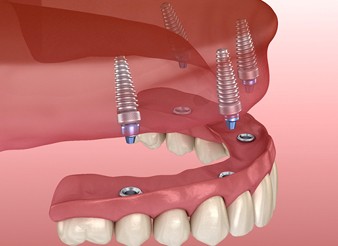 implant denture illustration