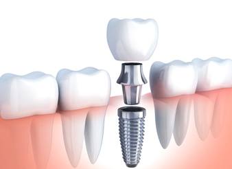 dental implant diagram