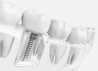 dental implant