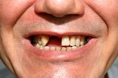 Man smiling to reveal missing teeth.