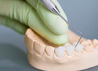 Model smile with fixed bridge restoration