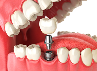 Animation of dental implant process