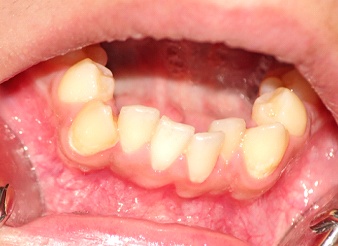 Crowded bottom teeth