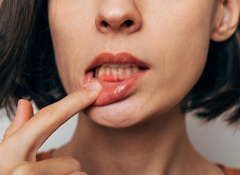 Woman with gum irritation 