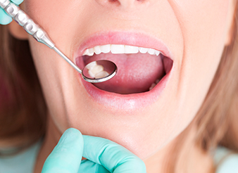 Closeup of patient during dental checkup