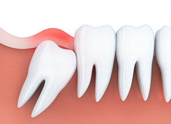 Animation of impacted wisdom tooth