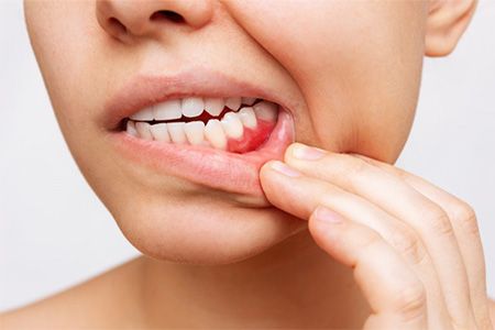 Woman pulling her lip back to reveal bleeding gums.