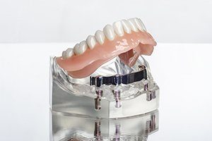 Implant Dentures