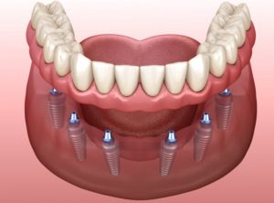 implant-retained dentures in Lewisville