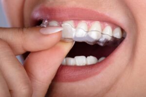 Closeup of fingers removing Invisalign from upper arch